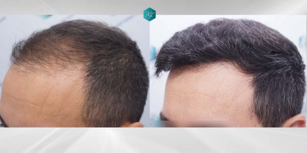 Injerto Capilar Técnica FUE Grafts 4.516 (11.888 Pelos) 84 90 COMPARATIVAS 4