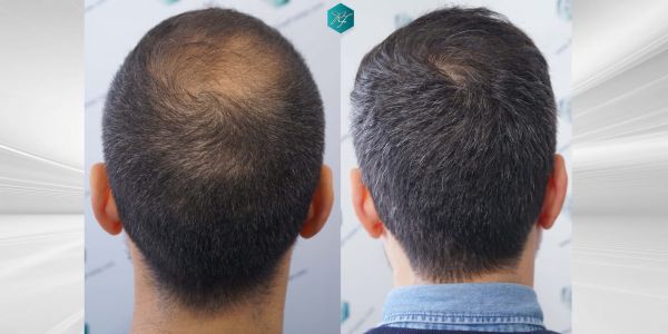 Injerto Capilar Técnica FUE Grafts 4.516 (11.888 Pelos) 86 92 COMPARATIVAS 5