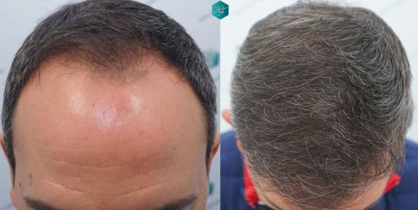 Injerto Capilar Técnica FUE Grafts 3362 (8806 Pelos) 51 COMPARATIVAS 2 1