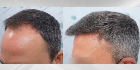 Injerto Capilar Técnica FUE Grafts 3362 (8806 Pelos) 53 COMPARATIVAS 3 2