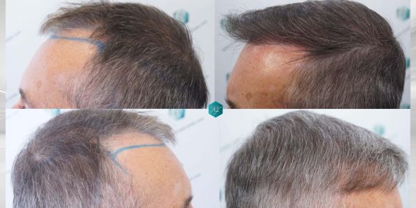 Injerto Capilar Técnica FUE Grafts 4924 (11170 Pelos) 70 COMPARATIVAS 3