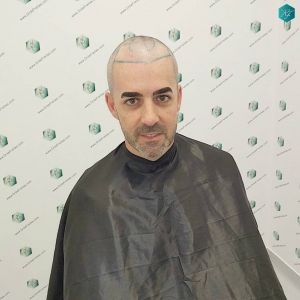 Injerto Capilar Técnica FUE Grafts 2925 (6546 Pelos) 1 DISENO LINEA INJERTO CAPILAR