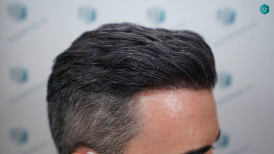 Injerto Capilar Técnica FUE Grafts 2925 (6546 Pelos) 7 10 RESULTADOS A LOS 12 MESES