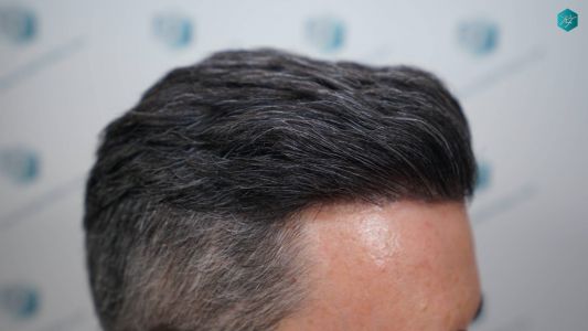Injerto Capilar Técnica FUE Grafts 2925 (6546 Pelos) 8 11 RESULTADOS A LOS 12 MESES