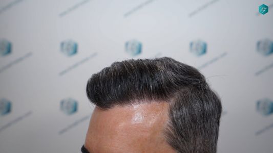 Injerto Capilar Técnica FUE Grafts 2925 (6546 Pelos) 9 12 RESULTADOS A LOS 12 MESES