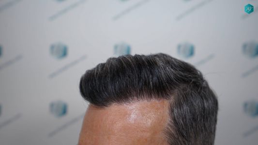 Injerto Capilar Técnica FUE Grafts 2925 (6546 Pelos) 10 13 RESULTADOS A LOS 12 MESES