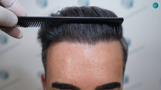 Injerto Capilar Técnica FUE Grafts 2925 (6546 Pelos) 11 14 RESULTADOS A LOS 12 MESES