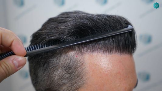 Injerto Capilar Técnica FUE Grafts 2925 (6546 Pelos) 12 15 RESULTADOS A LOS 12 MESES