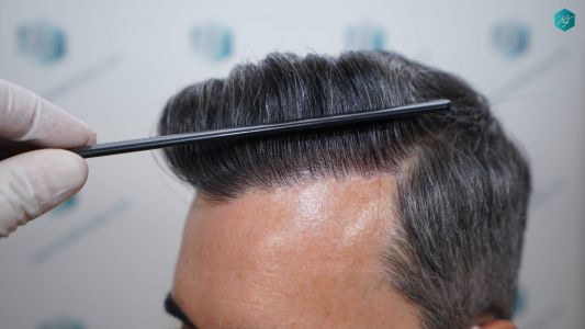 Injerto Capilar Técnica FUE Grafts 2925 (6546 Pelos) 13 16 RESULTADOS A LOS 12 MESES