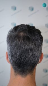 Injerto Capilar Técnica FUE Grafts 2925 (6546 Pelos) 14 17 RESULTADOS A LOS 12 MESES