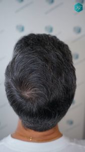 Injerto Capilar Técnica FUE Grafts 2925 (6546 Pelos) 15 18 RESULTADOS A LOS 12 MESES