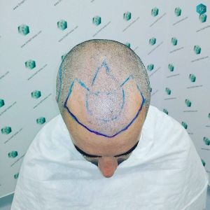 Injerto Capilar Técnica FUE Grafts 2925 (6546 Pelos) 2 2 DISENO LINEA INJERTO CAPILAR