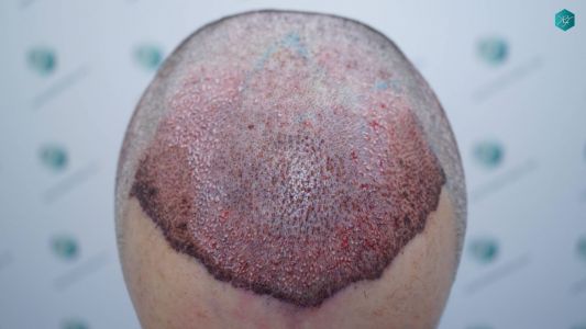 Injerto Capilar Técnica FUE Grafts 2925 (6546 Pelos) 3 4 TRASPLANTE CAPILAR