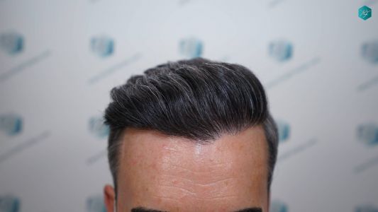 Injerto Capilar Técnica FUE Grafts 2925 (6546 Pelos) 6 9 RESULTADOS A LOS 12 MESES