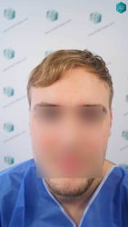 Injerto Capilar Técnica FUE Grafts 3002 (7139 Pelos) 1 ANTES DEL TRASPLANTE CAPILAR