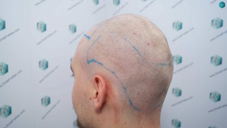 Injerto Capilar Técnica FUE Grafts 3002 (7139 Pelos) 14 13B DISENO LINEA INJERTO