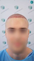TRASPLANTE DE PELO 16 TRASPLANTE DE PELO