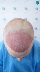 Injerto Capilar Técnica FUE Grafts 3002 (7139 Pelos) 17 17 TRASPLANTE DE PELO