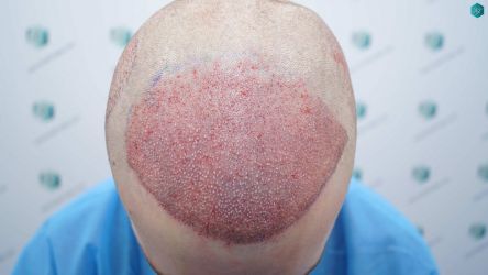 Injerto Capilar Técnica FUE Grafts 3002 (7139 Pelos) 18 18 TRASPLANTE DE PELO