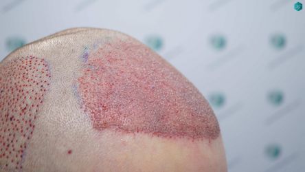 Injerto Capilar Técnica FUE Grafts 3002 (7139 Pelos) 20 20 TRASPLANTE DE PELO