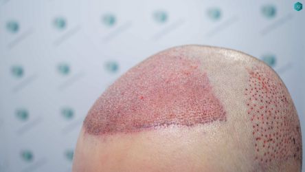 Injerto Capilar Técnica FUE Grafts 3002 (7139 Pelos) 21 21 TRASPLANTE DE PELO