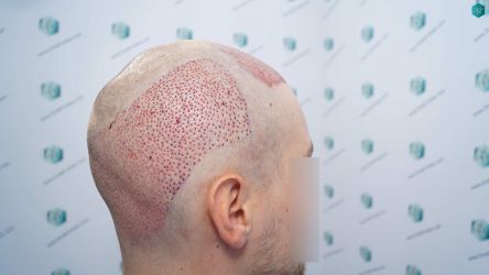 Injerto Capilar Técnica FUE Grafts 3002 (7139 Pelos) 22 22 TRASPLANTE DE PELO