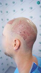 Injerto Capilar Técnica FUE Grafts 3002 (7139 Pelos) 23 23 TRASPLANTE DE PELO