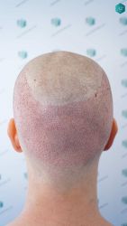 Injerto Capilar Técnica FUE Grafts 3002 (7139 Pelos) 24 24 TRASPLANTE DE PELO
