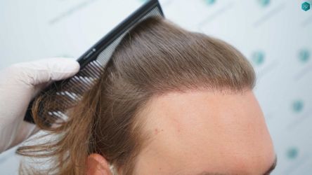Injerto Capilar Técnica FUE Grafts 3002 (7139 Pelos) 33 37 RESULTADOS 36 MESES TRASPLANTE CAPILAR
