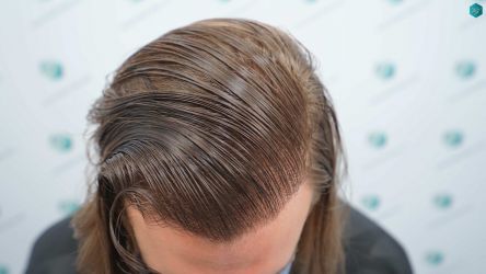Injerto Capilar Técnica FUE Grafts 3002 (7139 Pelos) 39 38AB RESULTADOS TRANSPLANTE DE PELO