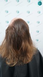 Injerto Capilar Técnica FUE Grafts 3002 (7139 Pelos) 45 43 RESULTADOS TRASPLANTE CAPILAR