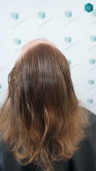 Injerto Capilar Técnica FUE Grafts 3002 (7139 Pelos) 46 43A RESULTADOS TRASPLANTE CAPILAR
