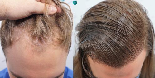 Injerto Capilar Técnica FUE Grafts 3002 (7139 Pelos) 51 49 COMPARATIVAS