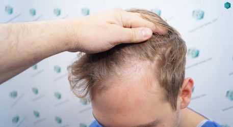 Injerto Capilar Técnica FUE Grafts 3002 (7139 Pelos) 5 5 ANTES DEL TRASPLANTE CAPILAR