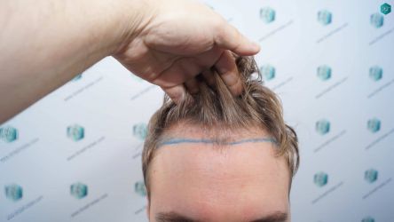 Injerto Capilar Técnica FUE Grafts 3002 (7139 Pelos) 7 7A DISENO LINEA INJERTO CAPILAR