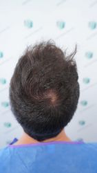 Injerto Capilar Técnica FUE Grafts 3589 (9178 Pelos) 9 10 ANTES DEL TRASPLANTE CAPILAR