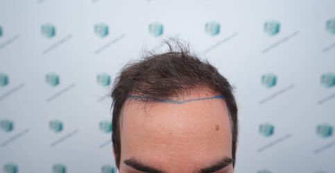 Injerto Capilar Técnica FUE Grafts 3589 (9178 Pelos) 10 12 DISENO LINEA DE INJERTO