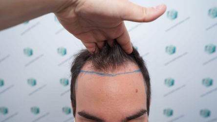 Injerto Capilar Técnica FUE Grafts 3589 (9178 Pelos) 11 14 DISENO LINEA DE INJERTO
