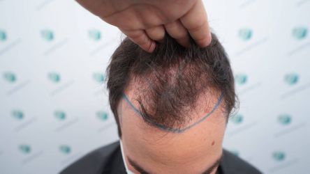 Injerto Capilar Técnica FUE Grafts 3589 (9178 Pelos) 12 15 DISENO LINEA DE INJERTO