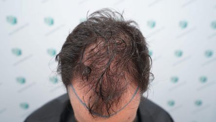 Injerto Capilar Técnica FUE Grafts 3589 (9178 Pelos) 14 17 DISENO LINEA DE INJERTO
