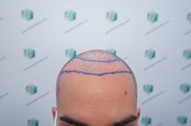 Injerto Capilar Técnica FUE Grafts 3589 (9178 Pelos) 15 18A DISENO LINEA DE INJERTO
