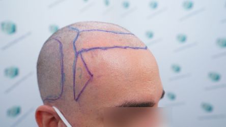 Injerto Capilar Técnica FUE Grafts 3589 (9178 Pelos) 16 18B DISENO LINEA DE INJERTO