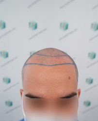 Injerto Capilar Técnica FUE Grafts 3589 (9178 Pelos) 18 19 DISENO LINEA DE INJERTO