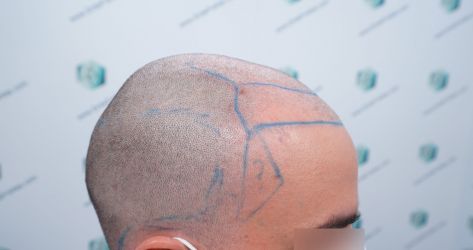 Injerto Capilar Técnica FUE Grafts 3589 (9178 Pelos) 20 21 DISENO LINEA DE INJERTO