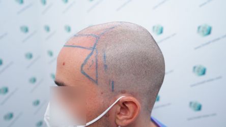 Injerto Capilar Técnica FUE Grafts 3589 (9178 Pelos) 21 23 DISENO LINEA DE INJERTO