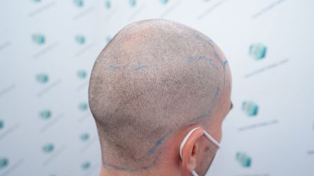 Injerto Capilar Técnica FUE Grafts 3589 (9178 Pelos) 22 24 DISENO LINEA DE INJERTO
