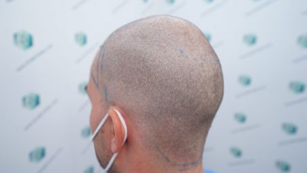 Injerto Capilar Técnica FUE Grafts 3589 (9178 Pelos) 23 25 DISENO LINEA DE INJERTO