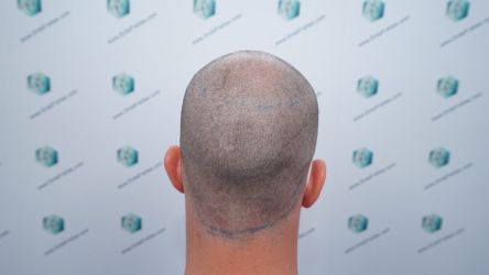 Injerto Capilar Técnica FUE Grafts 3589 (9178 Pelos) 24 26 DISENO LINEA DE INJERTO