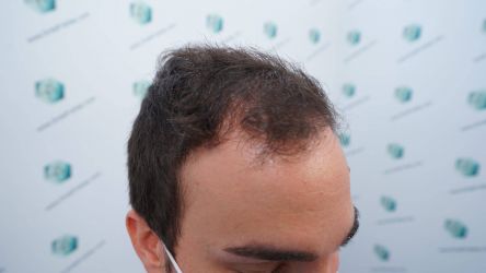 Injerto Capilar Técnica FUE Grafts 3589 (9178 Pelos) 2 3 ANTES DEL TRASPLANTE CAPILAR