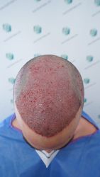 Injerto Capilar Técnica FUE Grafts 3589 (9178 Pelos) 25 30 TRASPLANTE CAPILAR